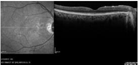 Ischemic Optic Neuropathy CRVO Leber s