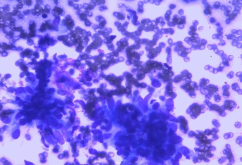The smears were studied for cytological details and diagnosis. The biopsied specimens of the above cases were processed routinely and stained with Hematoxylin and Eosin stain and examined.