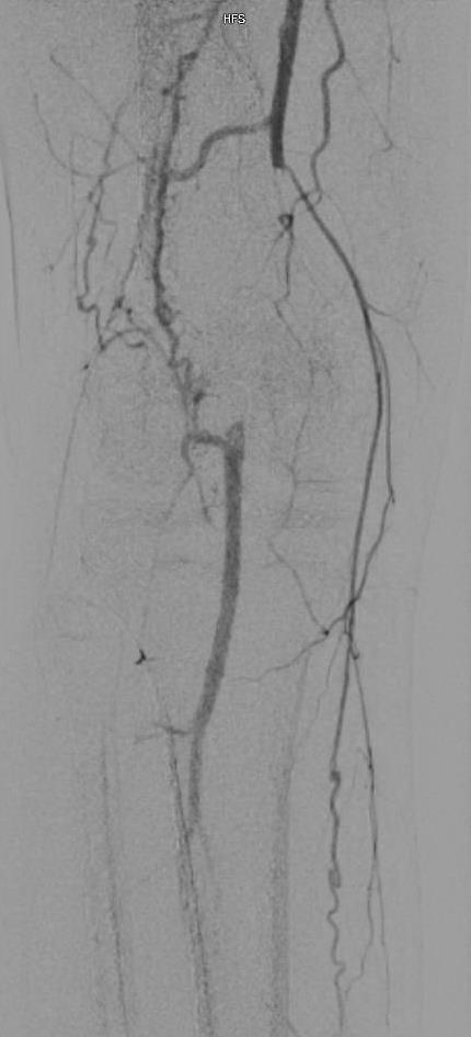 Angiogram with attempted lysis Multilevel occlusions with Distal PT patent
