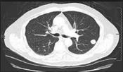 AI-ASSISTED LDCT LUNG CANCER SCREENING Accuracy 100 98.2% RADIOLOGIST INTERPRETED LDCT CASES Untrained Neural Network Trained with 98.