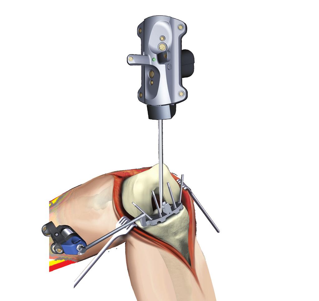 Product Guide 9 Register Tibia Fixation Plate Attachment Before tibia registration, a Fixation Plate has to be