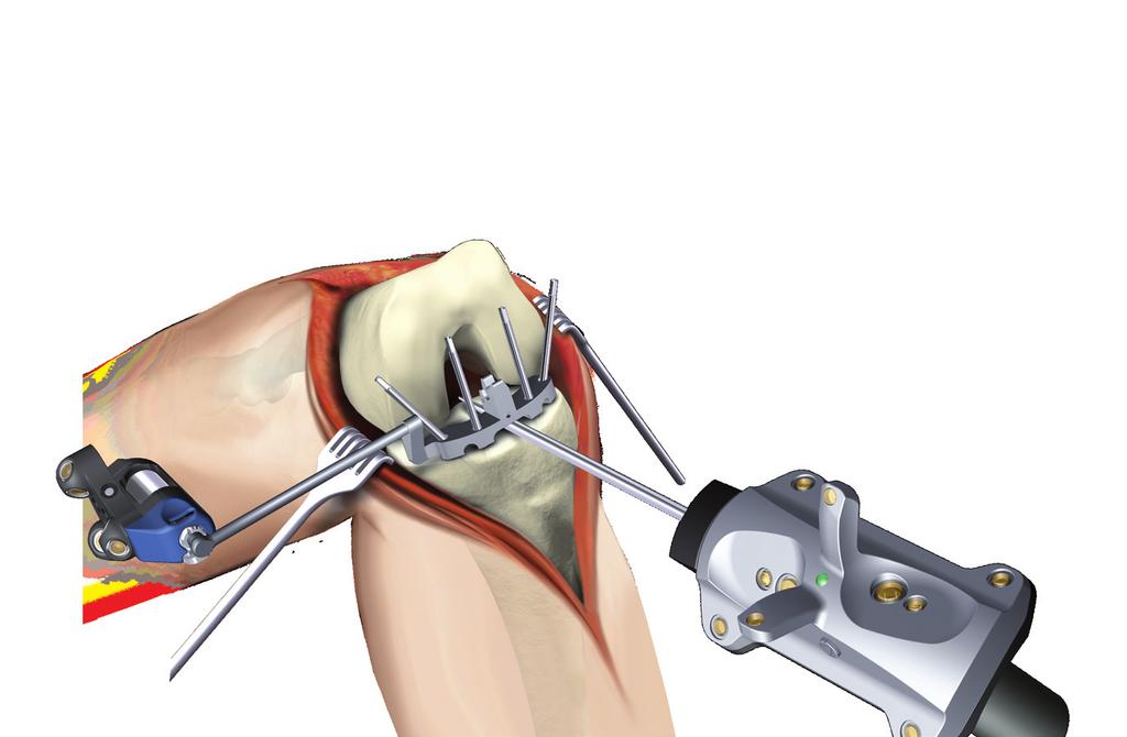 Upon proper fixation, mount the tibial tracker (blue) to the fixation plate.