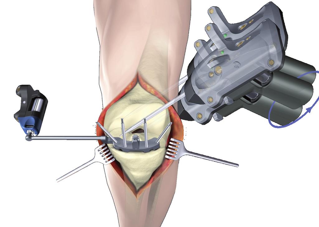 9 Register Tibia Medial Compartment Place pointer s tip on the medial compartment and begin digitizing