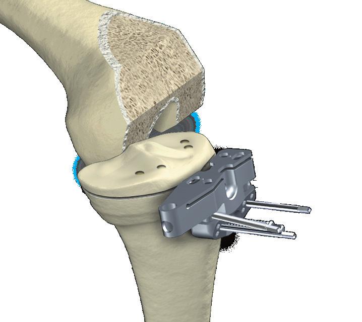 On the screen, the yellow disc depicts the actual cutting guide position. Additionally, the varus/valgus alignment, slope, and medial and lateral resection depth are numerically displayed.