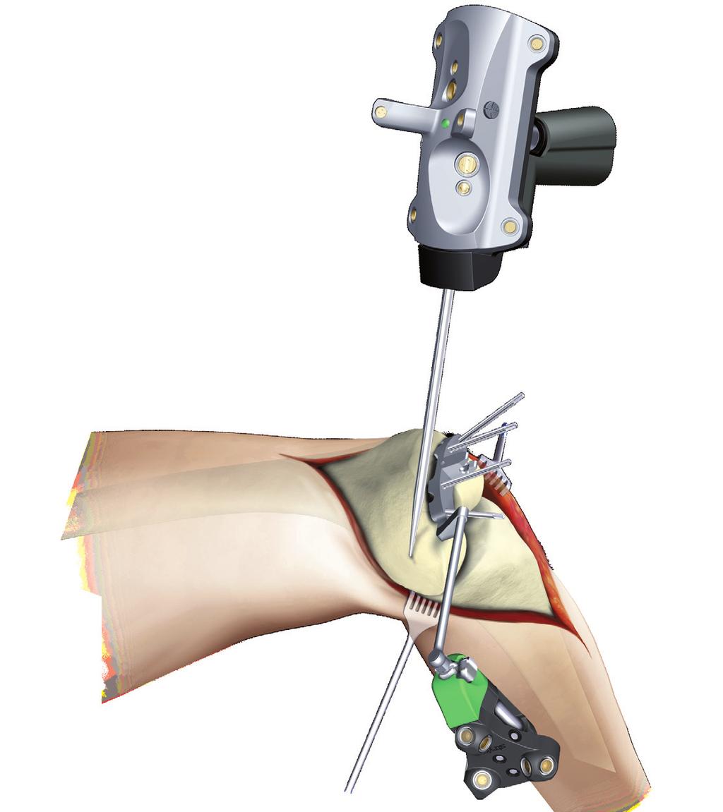 Lateral Epicondyle Place pointer s tip on the most lateral aspect of the origin of the lateral collateral ligament and press the pointer s SELECT