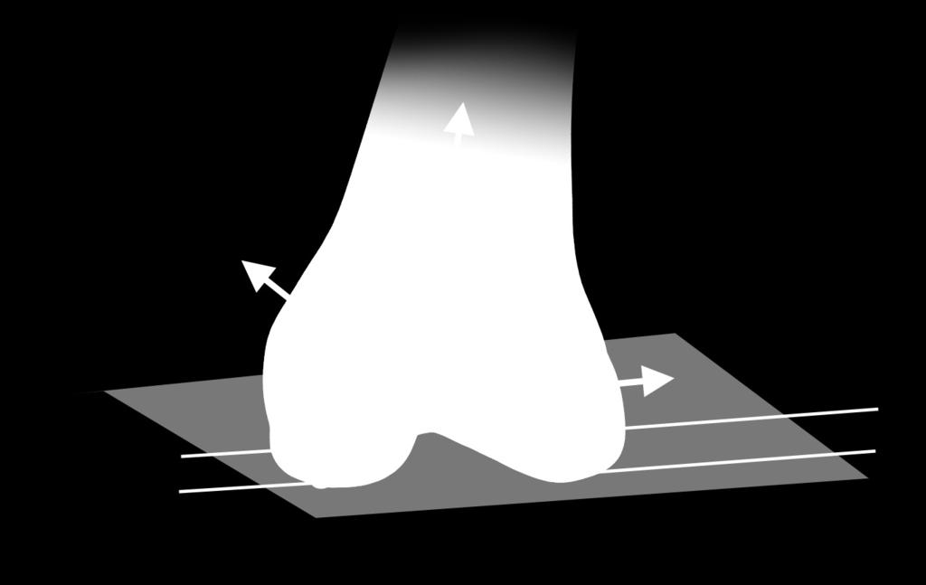 distal point of the digitized condyle.