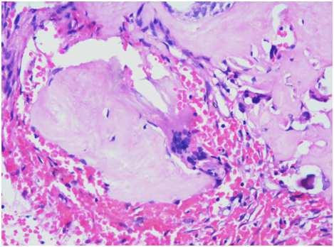 Definitive diagnosis can be made histologically only. 9 The histologic picture of CCOT can be very varied. The epithelial lining of CCOT has characteristic odontogenic/ ameloblastic features.