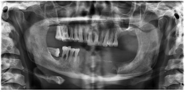 CONCLUSION The present case report demonstrates that CCOT can occur in the sixth decade of life also and can mimic a peri apical cyst being associated with attrited and non-vital teeth.