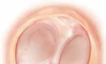 Tympanoplasty Tympanoplasty is surgery to repair a hole in the eardrum by covering the hole with a patch (graft). Repairing the eardrum can improve hearing. Tympanoplasty also stops ear drainage.