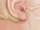 Mastoidectomy Mastoidectomy is done to remove growths and infected bone from the middle ear. It may or may not improve your hearing in the affected ear.