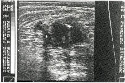 Figure 3. Transverse scan of the right iliac fossa showing an appendiceal mass. A mixed density mass with poorly defined boundaries. The hyperechoic area possibly represents gas or mucus.
