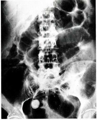 Gas-filled large and small bowel loops are also present. Gallstone ileus was also considered. A perforated appendix with abscess and appendicolith were found at surgery.