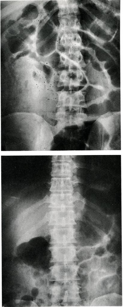 Figures 5 and 6. Two separate patients with plain supine abdominal x-raysshowing the "colon cut off" sign.