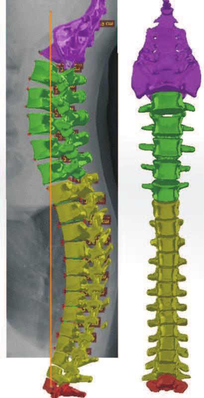 with a step of 5 and subsequent fixation of pelvis in this position, returning the seventh cervical vertebra to its normal position to restore the plumb line; 2) PT reduced to 25 from the original in