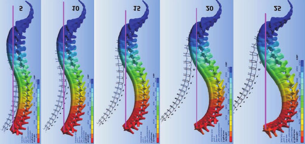 Figure 2. Changes in the sagittal profile of the spine with an increase in the initial pelvic anteversion in steps of 5. Figure 3.