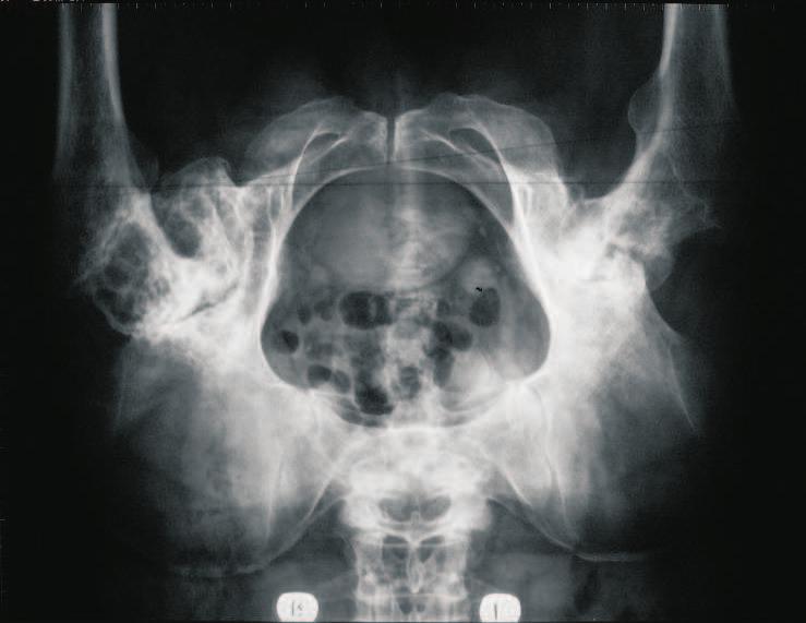 Figure 6. Review X-ray of the patient s pelvis D. Aseptic necrosis of the head of the femoral bones of the fourth degree, secondary bilateral coxarthrosis of the third degree. Figure 7.