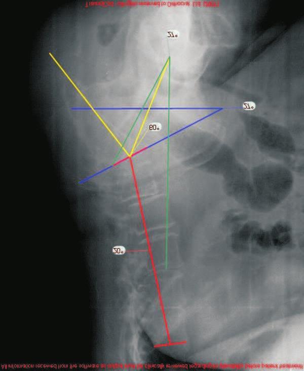 Figure 8. Sagittal X-ray of the patient s pelvis-spine complex.