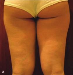 556 Review Cellulite therapy update Figure 2: Female patient before treatment (a); and after eight treatments with SmoothShapes (b). Standard digital photography was utilized.