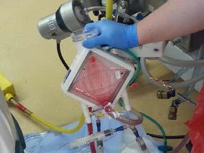 Whole-Lung Lavage Improvements in technology has made easier & safer 75% of Adult ECMO Pts have been