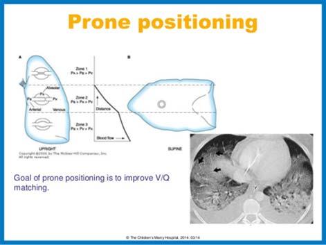 Prone Positioning Improves V/Q matching, secretion clearance and lymphatic drainage Assists recruitment of