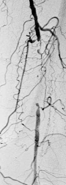 Peripheal artery