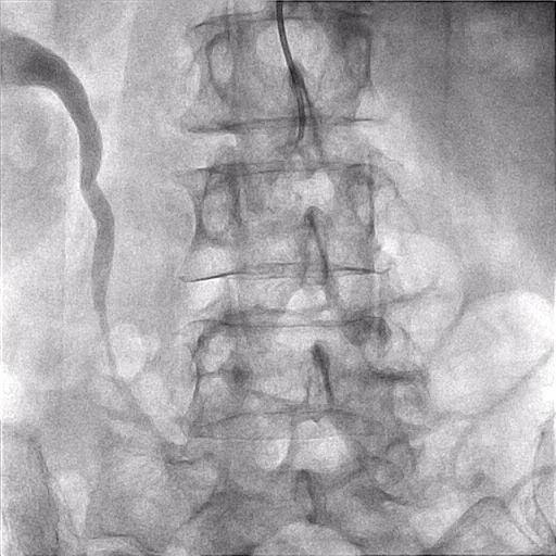 Aorta angioplasty (2007-3-29)