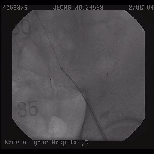 Aorta angioplasty