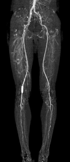 Lower Extremity CT Angiography Patent Rt. popliteal artery stent.