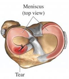 Knee Related Problems Examining Your Knee Meniscal Cartilage Tear Often caused by sudden twisting or continued squatting, a tear of this nature can produce swelling or pain.