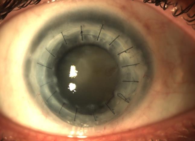 Corneal thinning and pending