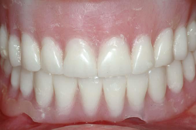 The Diagnostic Phase The patients upper and lower dentures are remade first to establish