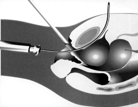 Figure 3 - SAFYRE TM is attached to the needle and pulled out to the suprapubic area. Surgical Technique Two 0.