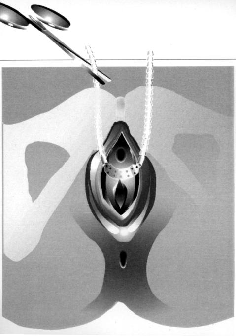Figure 4 - A Metzenbaum scissors is placed between the tape and the urethra for proper tension adjustment. Figure 5 - The final aspect of the sling in place.