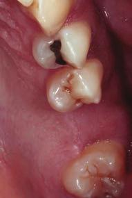 These forces can result in unintended movement of adjacent teeth, apical root resorption, and disruption of occlusal harmony, including supraeruption and canting.