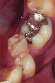 For example, a temporary crown with a bonded bracket can be cemented to an implant, which can then be used as anchorage for intrusion, extrusion, rotation, or tipping of the adjacent tooth without