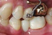 Case 1 A 43-year-old male was evaluated for prosthodontic treatment of the left posterior dentition.