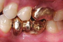 Use of Osseointegrated Implants for Orthodontic Anchorage Fig. 3 Case 1.