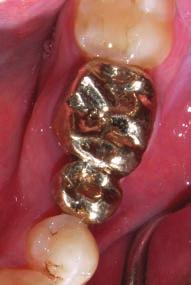 Restorative treatment consisted of an implant-supported full gold crown on the upper left first molar and fixed dental prostheses for the lower left first molar and cantilevered lower left second