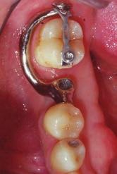 After 18 weeks of treatment, the button on the lower right second molar was removed, and a final full Type III gold