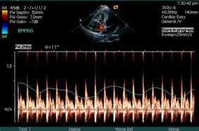 Factors Influencing Doppler Blood Flow and its Measurements 155 Fig. 8. Doppler spectra across the tricuspid valve with the intrathoracic pressure decrease of 4mmHg in the same subject as in figure 1.