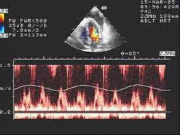 156 Establishing Better Standards of Care in Doppler Echocardiography, Computed Tomography and Nuclear Cardiology 4.1.3 Influence of spontaneous respiration on Doppler flow measurements in patients with pericardial effusion 4.