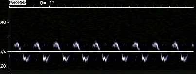 160 Establishing Better Standards of Care in Doppler Echocardiography, Computed Tomography and Nuclear Cardiology Fig. 19. Doppler signal derived from only the motion of the tubing.