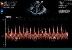1.2 Pulmonary veins The systolic peak flow velocity (PVs) and its integral (PV VTIs) of the pulmonary vein did not vary dramatically between inspiration and expiration; however, the diastolic peak