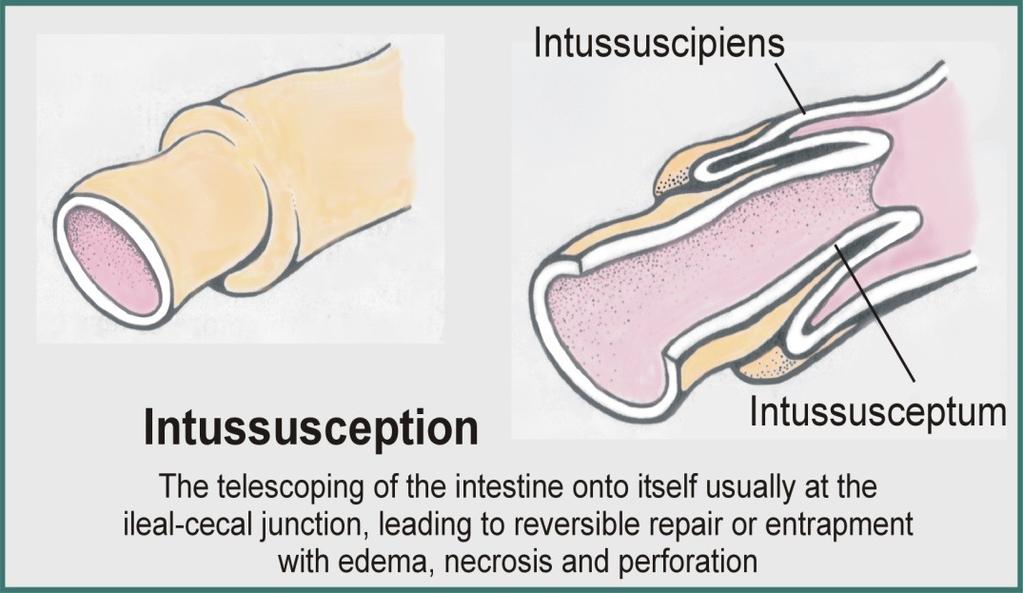 Intussusception 1