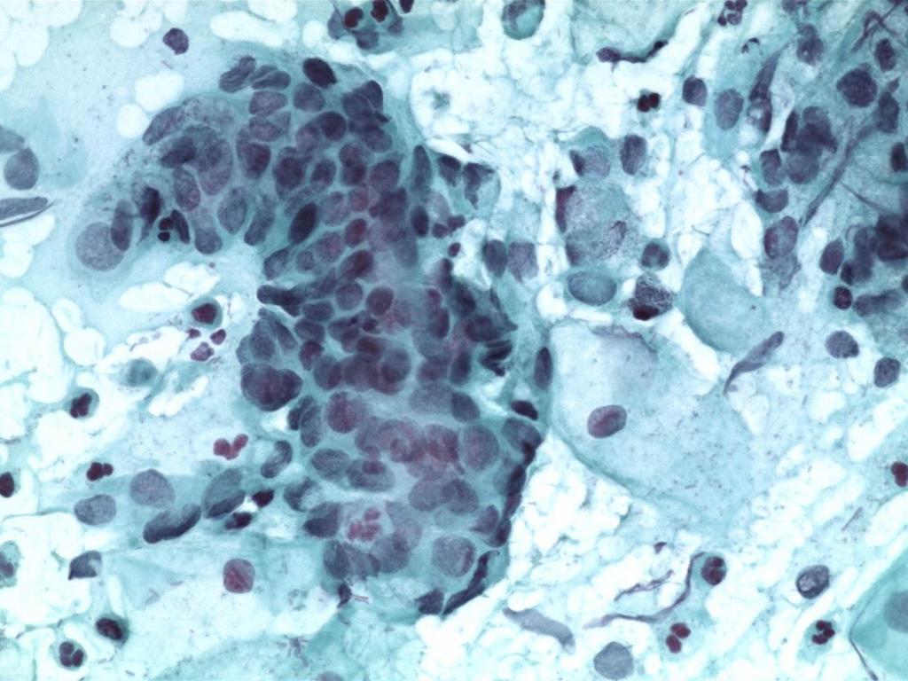 2007: cytology H SIL and inflammation