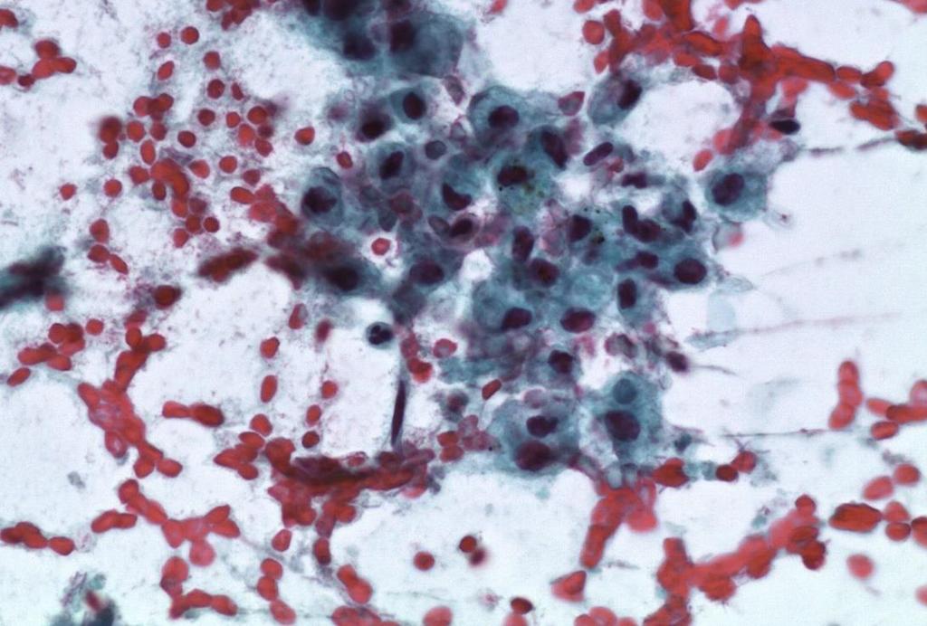 2008: cytology benign cellular