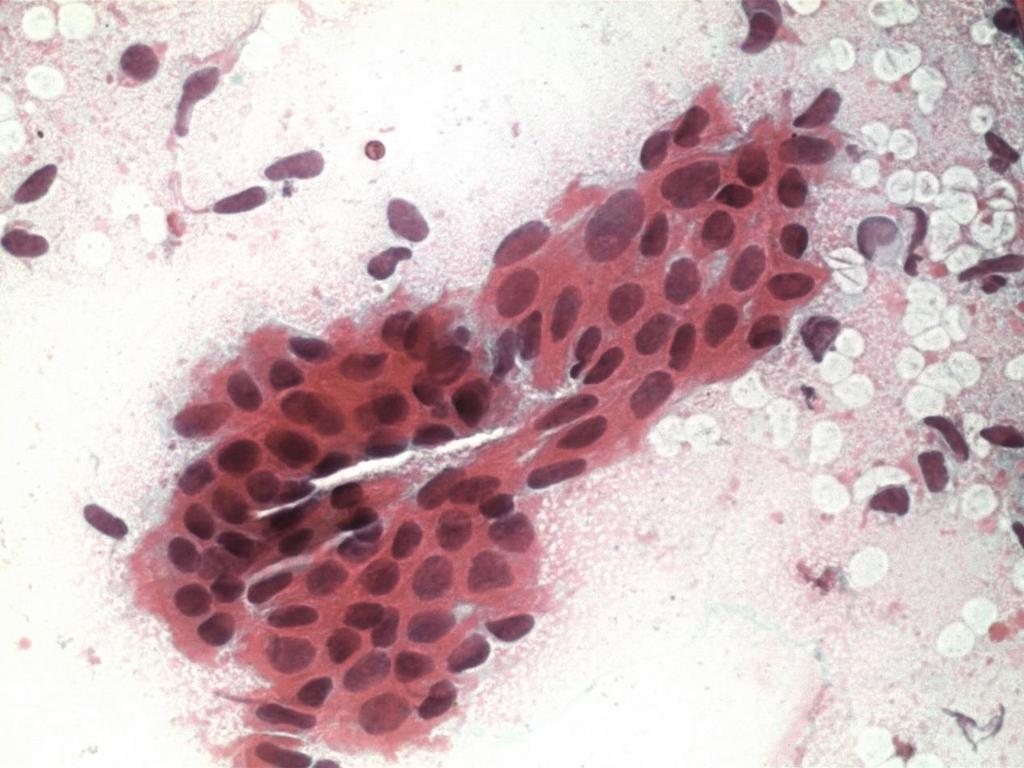 June 2010: cytology LSIL December