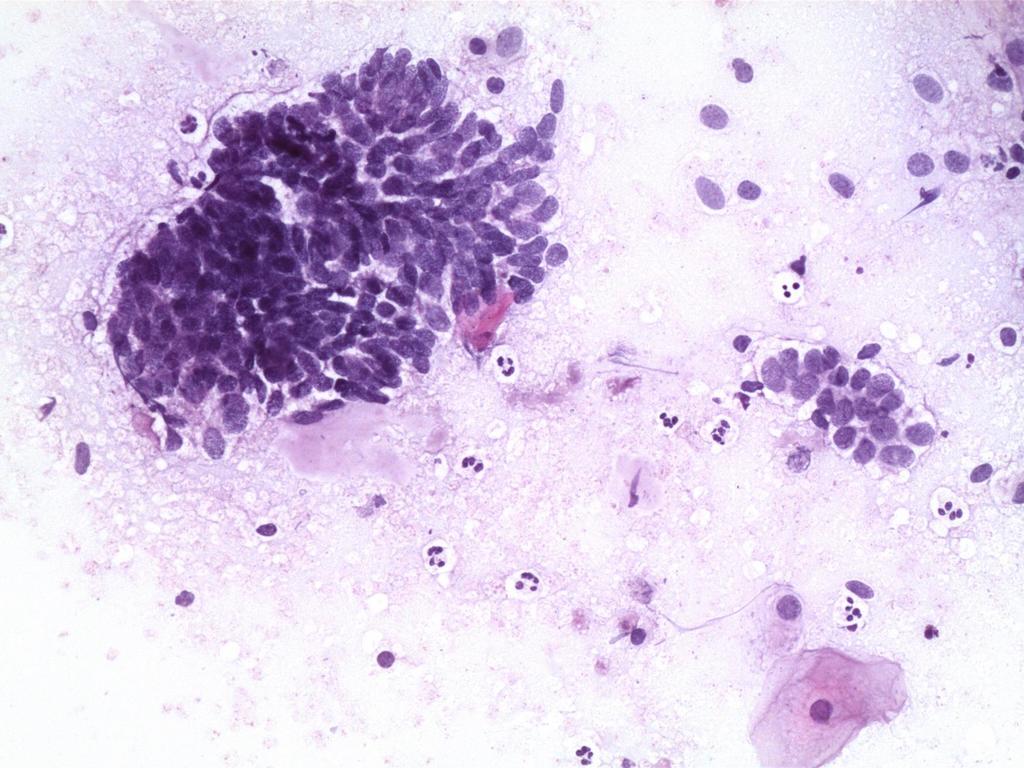 June 2015: cytology ASC-US