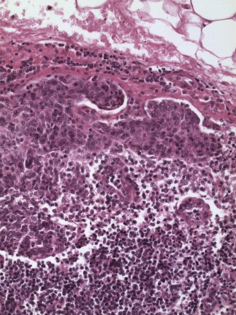 pt1b1, N1; micrometastasis in one