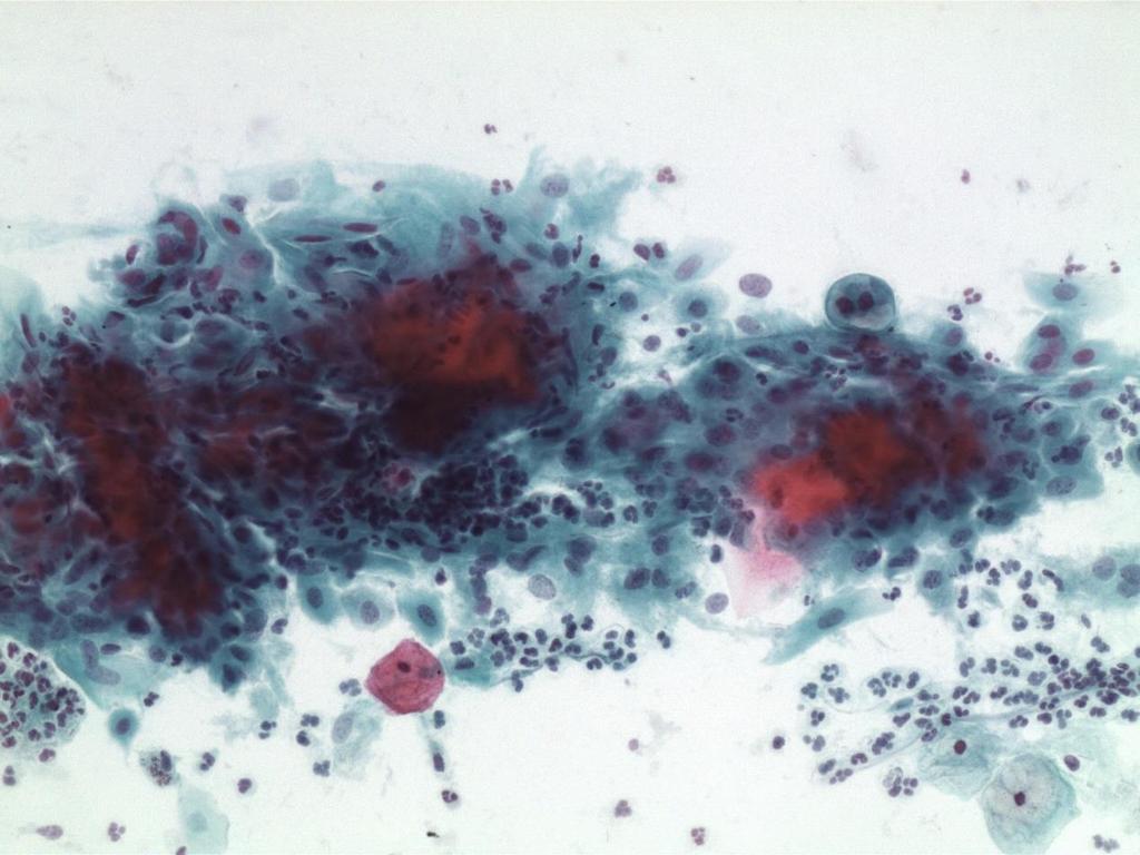 cytology - vaginal fornix - NILM